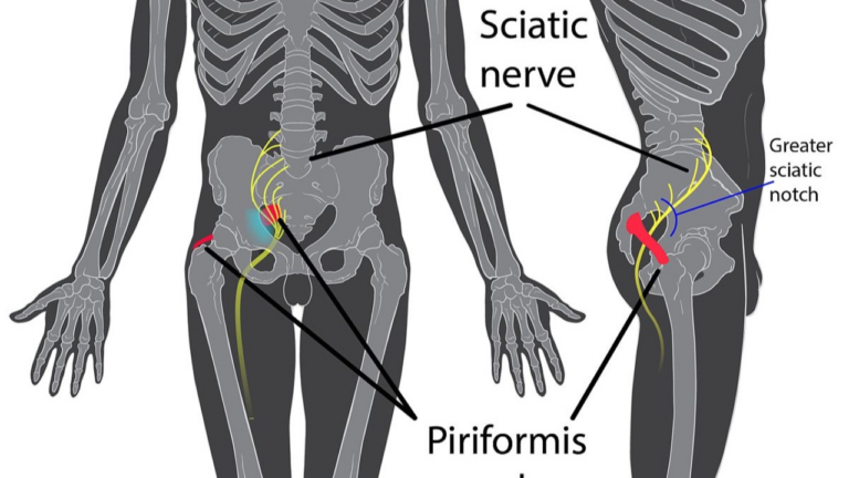 sciatica pain solutions