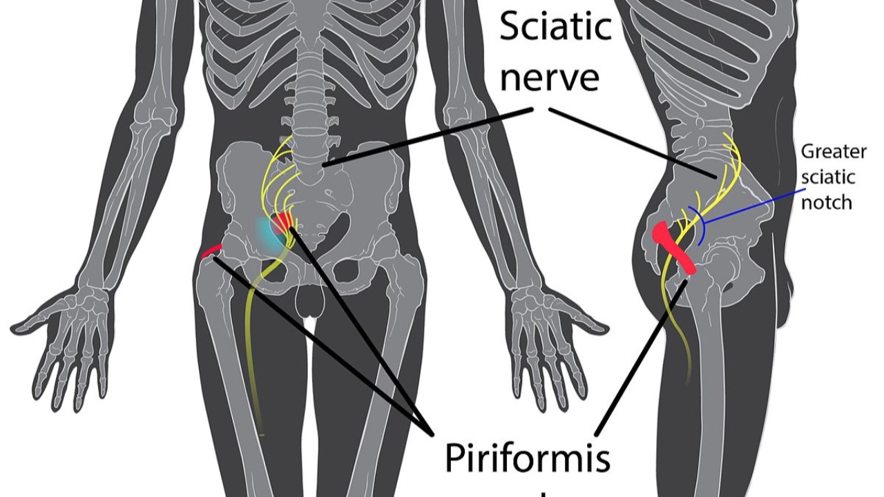 sciatica pain solutions