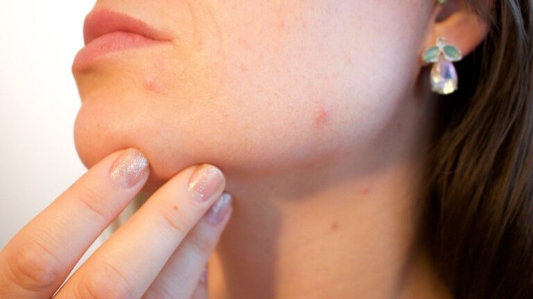 natural treatment for acne