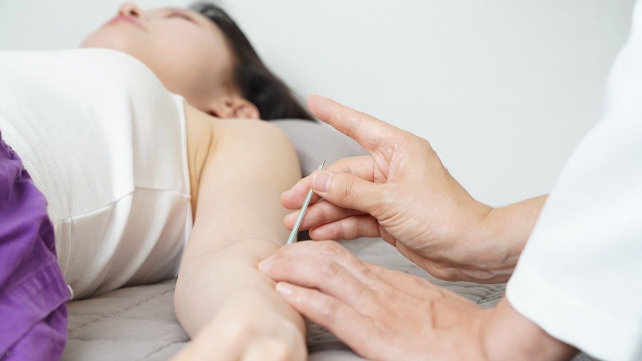 acupuncture