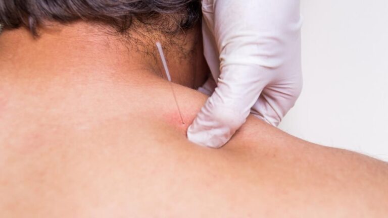dry needling vs acupuncture