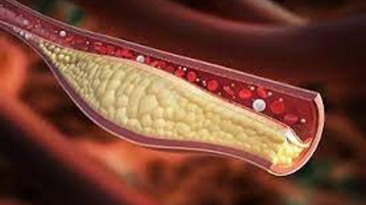 high cholesterol medication