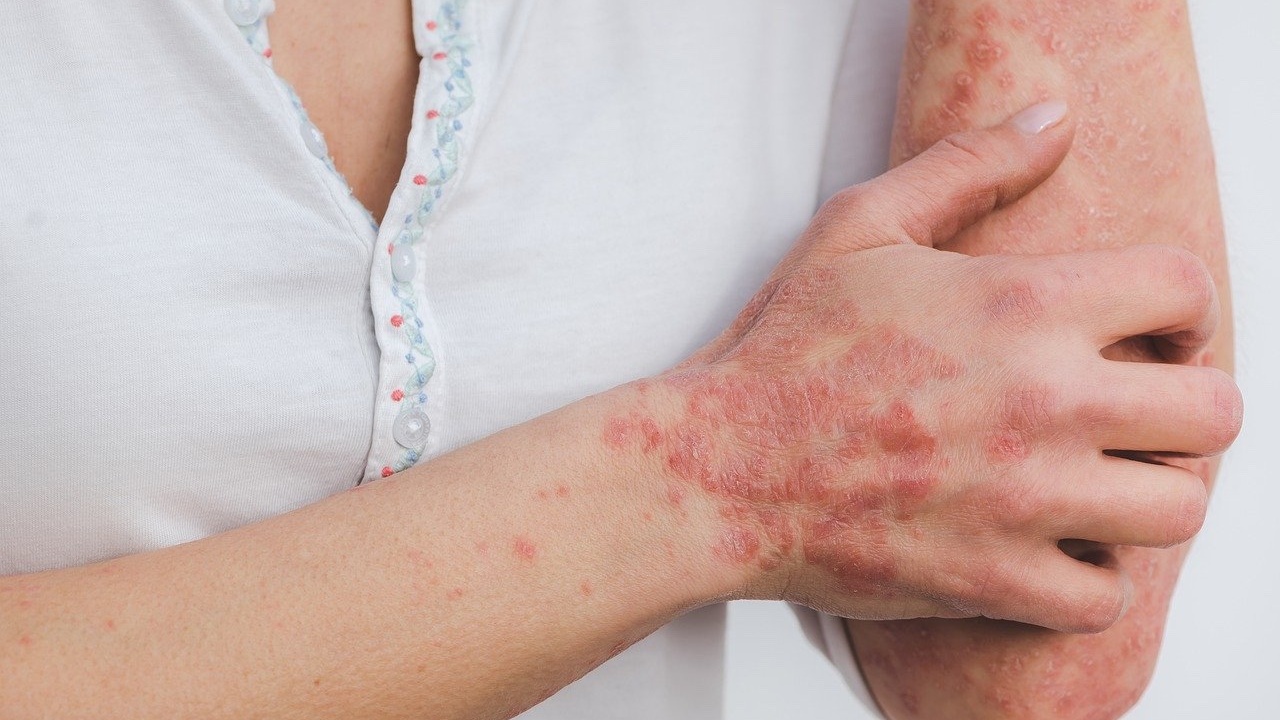 natural treatment for eczema, hives, psoriasis