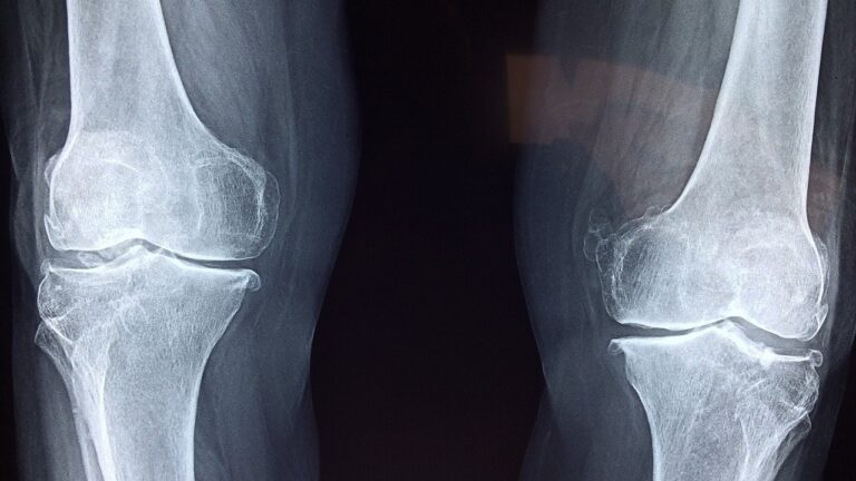 knee pain relief